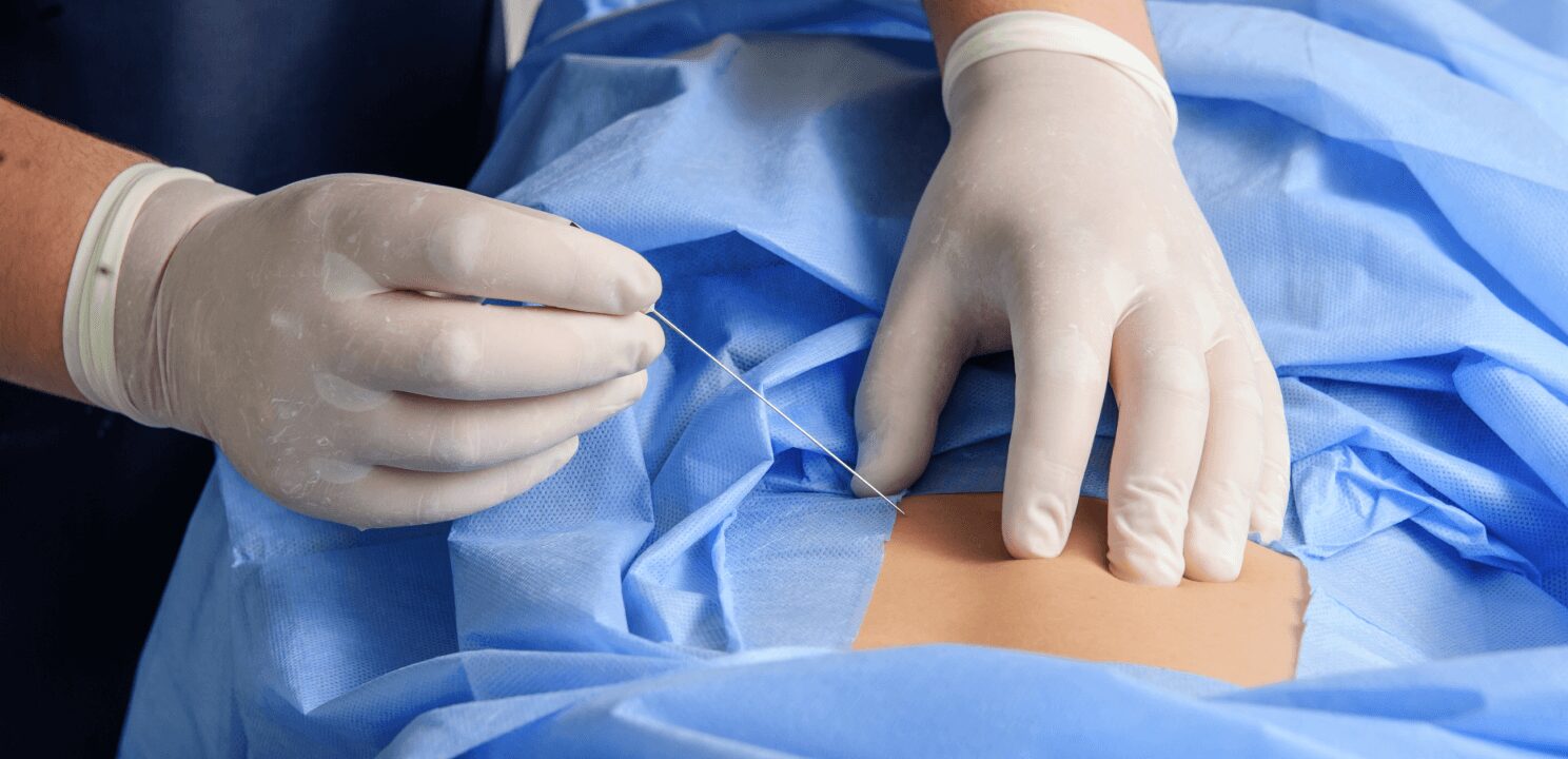 Lumbar Sympathetic Blocks