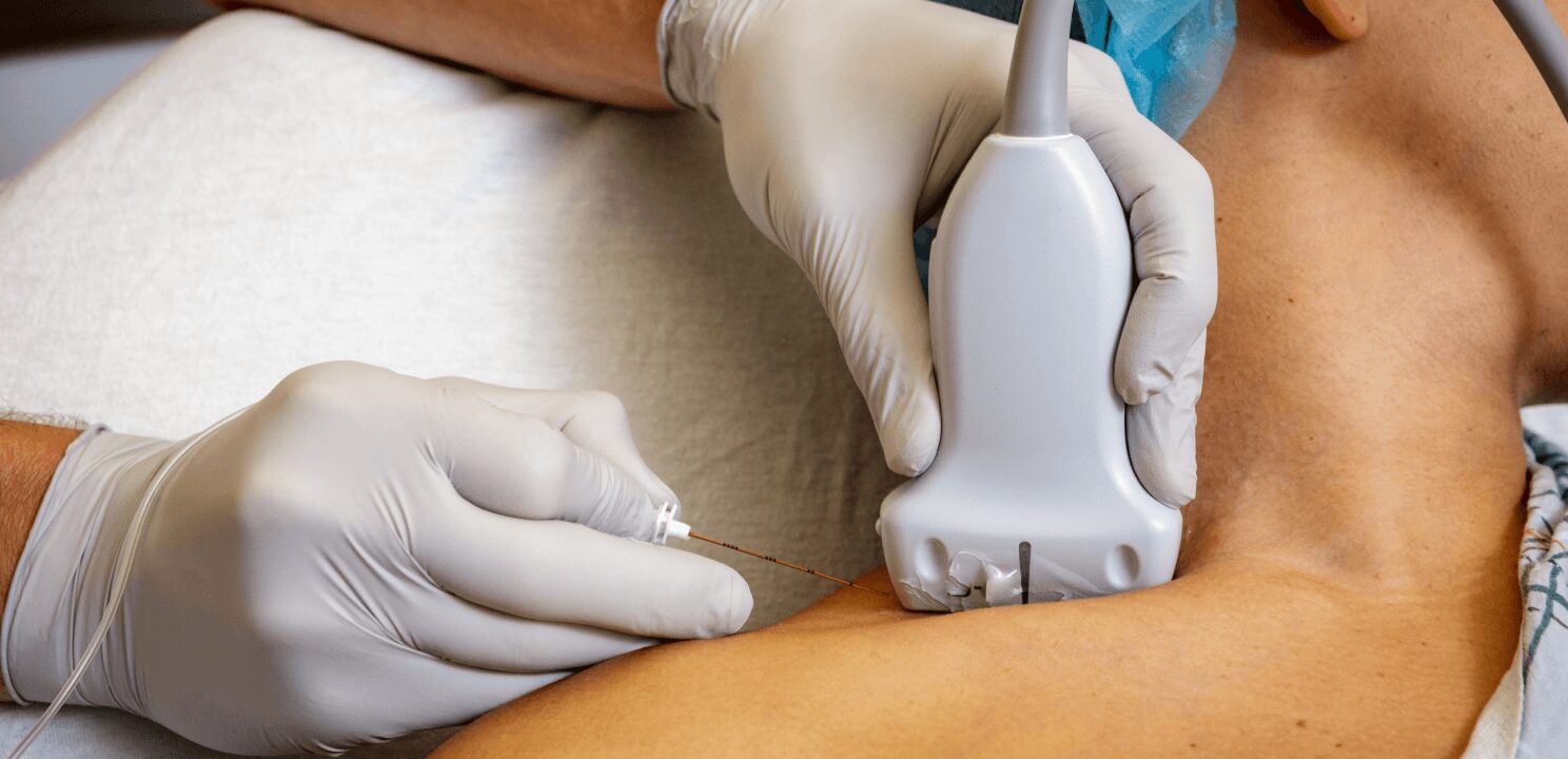 Peripheral Nerve Blocks